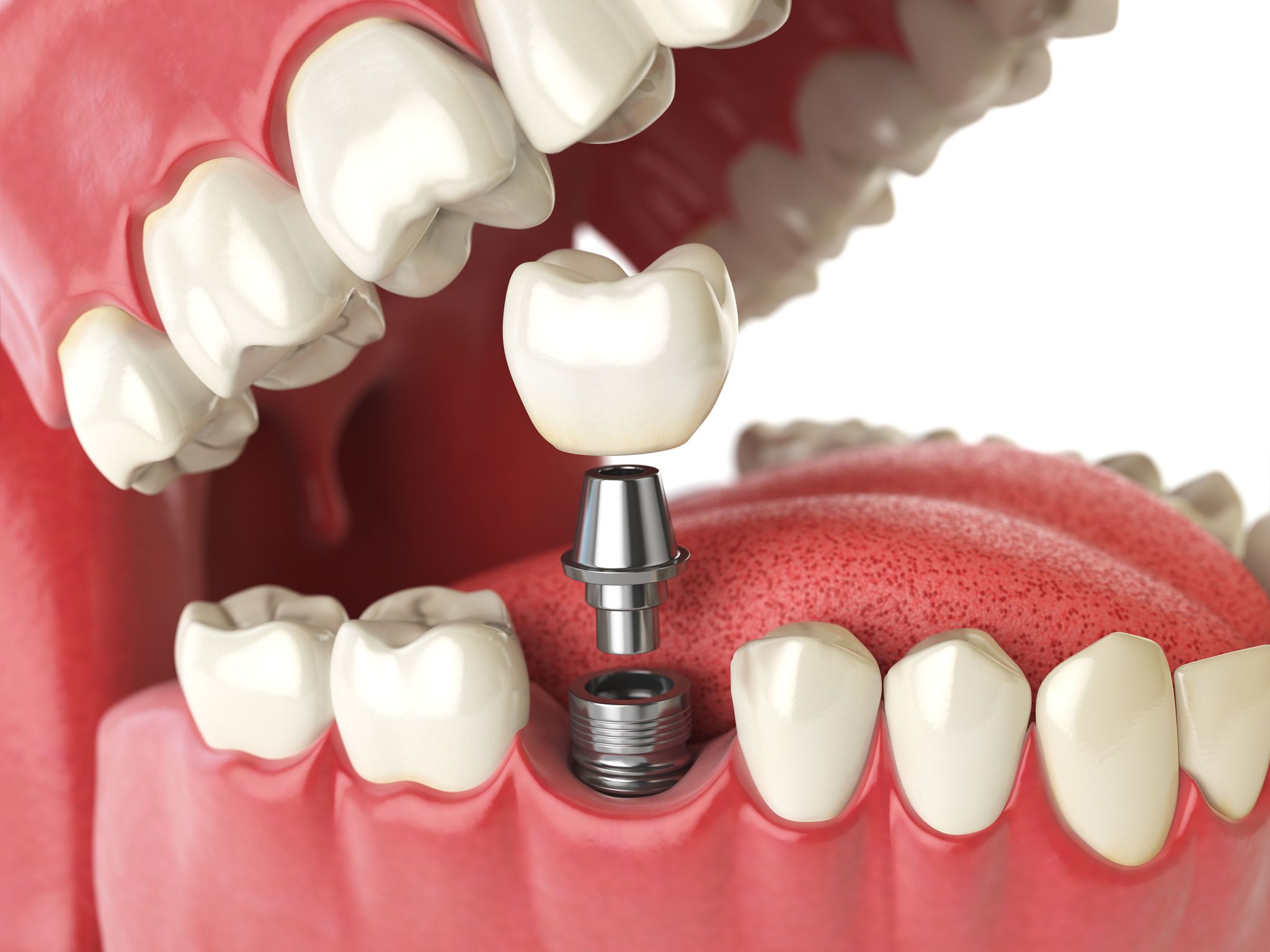 dental implants in Toronto Beaches