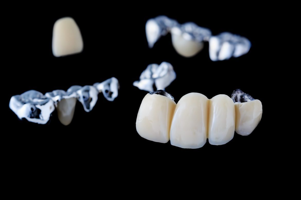 replacing teeth with dental bridges