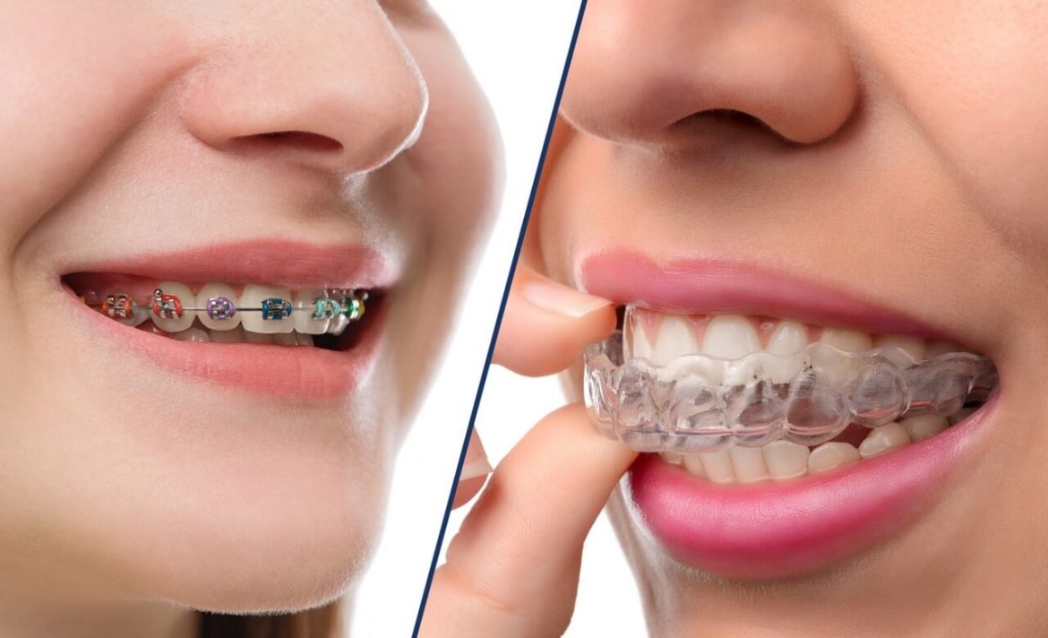 Metal Braces: Does This Traditional Dental Technology Have a Future?