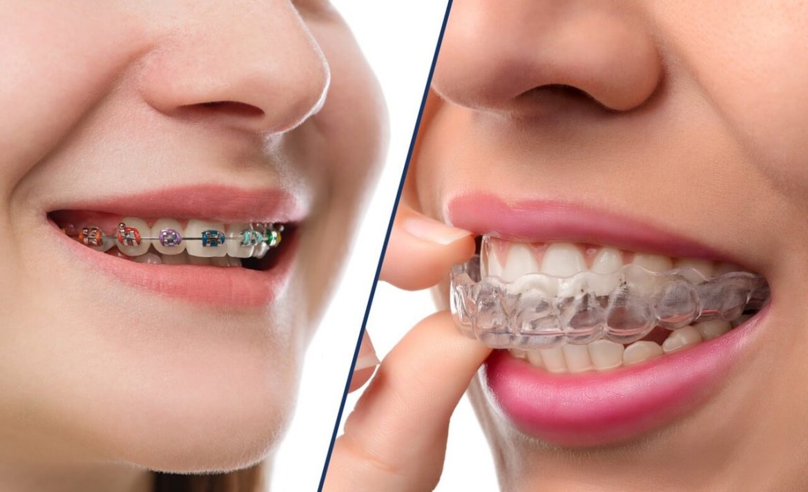 Invisalign Invisible Braces in Toronto